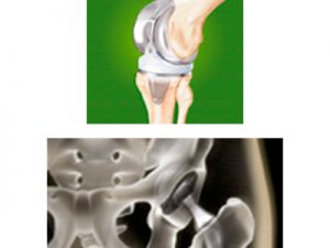 Künstliches Hüft- / Kniegelenk | Orthopädie Schlosscarree